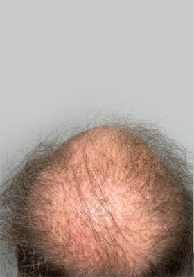 hair transplant before after Photos