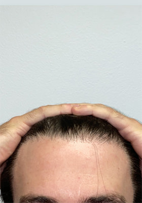 hair transplant before after Photos