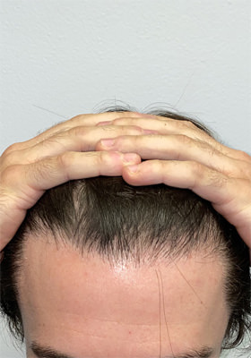 hair transplant before after Photos