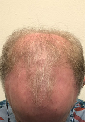 hair transplant before after Photos