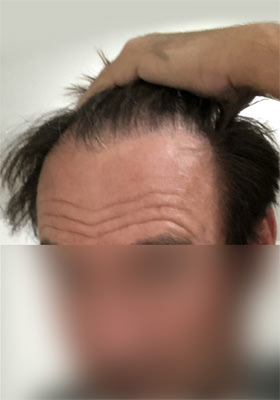 hair transplant before after Photos