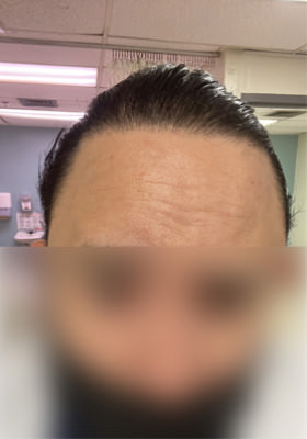 hair transplant before after Photos