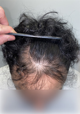 hair transplant before after Photos