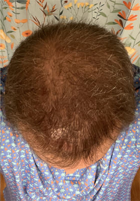 hair transplant before after Photos