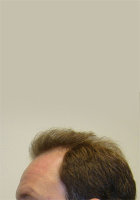 hair transplant before after Photos