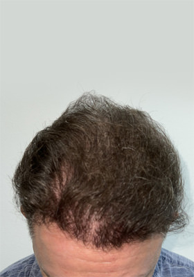 hair transplant before after Photos