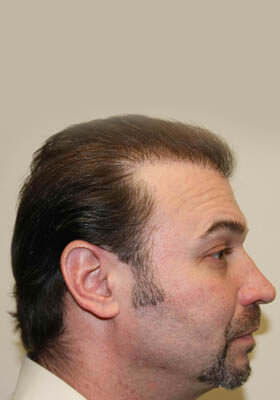 hair transplant before after Photos