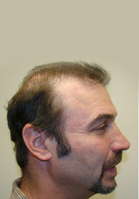 hair transplant before after Photos