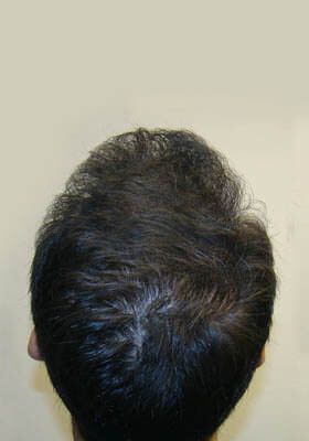 hair transplant before after Photos