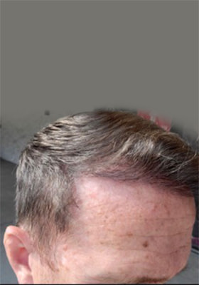 hair transplant before after Photos