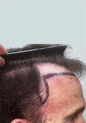 hair transplant before after Photos