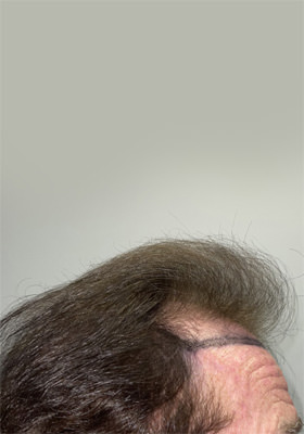 hair transplant before after Photos