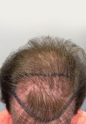 hair transplant before after Photos