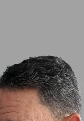 hair transplant before after Photos