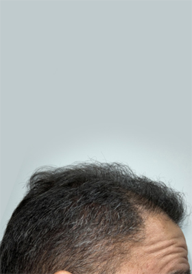 hair transplant before after Photos