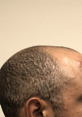 hair transplant before after Photos