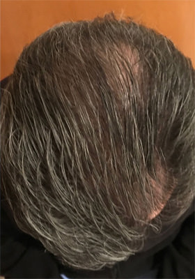 hair transplant before after Photos