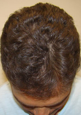 hair transplant before after Photos