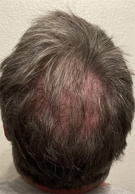 hair transplant before after Photos