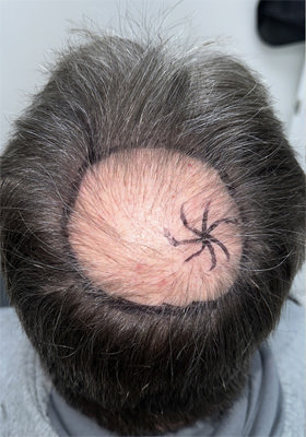 hair transplant before after Photos