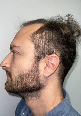 hair transplant before after Photos