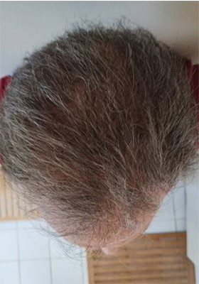 hair transplant before after Photos