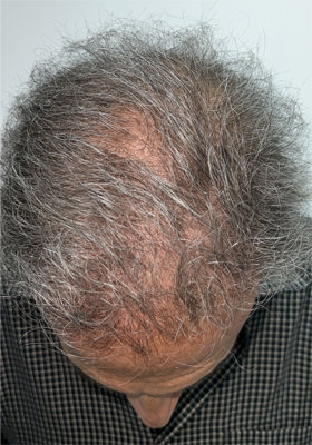 hair transplant before after Photos