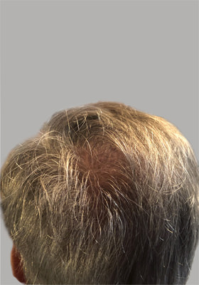 hair transplant before after Photos