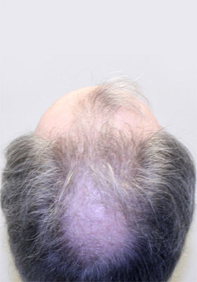 hair transplant before after Photos