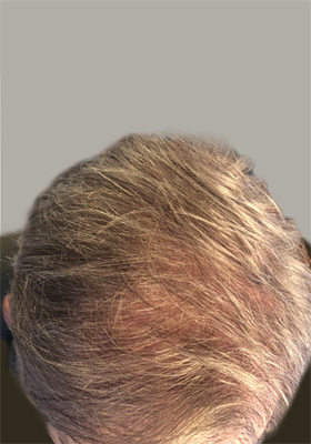 hair transplant before after Photos