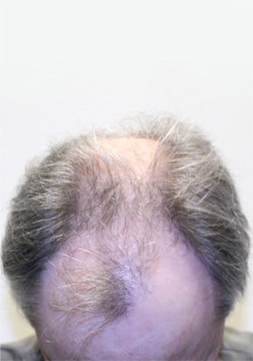 hair transplant before after Photos