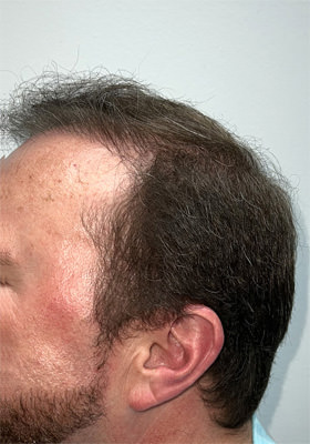 hair transplant before after Photos