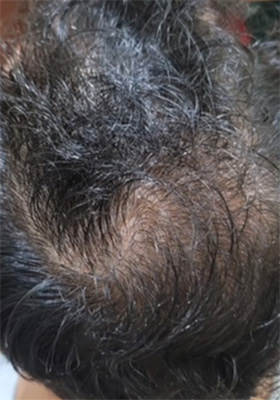 hair transplant before after Photos