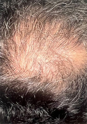 hair transplant before after Photos