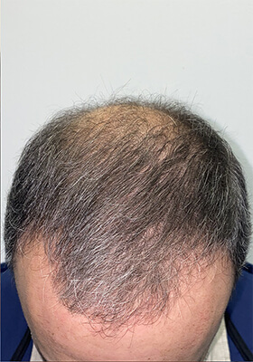 hair transplant before after Photos