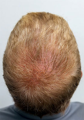 hair transplant before after Photos
