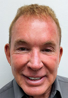 hair transplant before after Photos