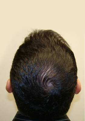 hair transplant before after Photos