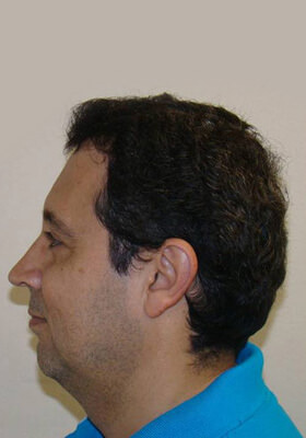 hair transplant before after Photos