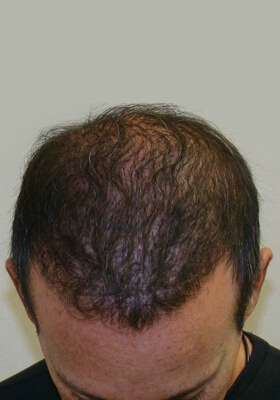 hair transplant before after Photos