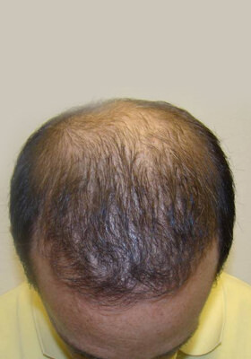 hair transplant before after Photos