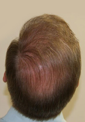 hair transplant before after Photos