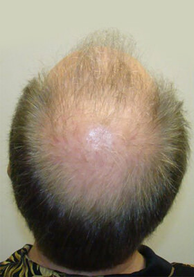 hair transplant before after Photos