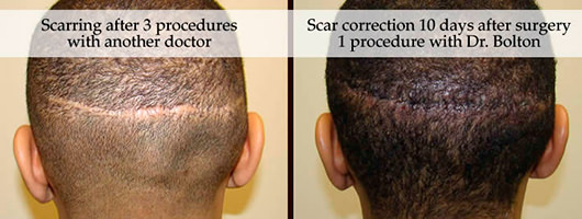 Afraid of Scarring? Before And Afters Hair Transplant Industry Exposed Suture Line/Scar 
