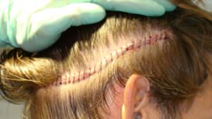 Dr. Bolton Specializes in Leaving Virtually No Scar While Yielding More Hair Hair Transplant Industry Exposed Suture Line/Scar 