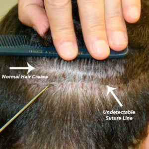 Another Undetectable Scar After Hair Transplant Hair Transplant Industry Exposed Suture Line/Scar 