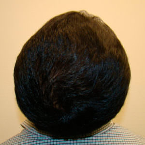 Balding Early? - No Problem. Before And Afters Crown Difficult Cases MaxHarvest Plus™ Procedures 