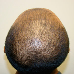 Balding Early? - No Problem. Before And Afters Crown Difficult Cases MaxHarvest Plus™ Procedures 