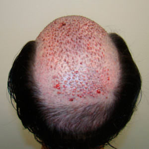 7 Prior Procedures Don't Compare To 1 Dr. Bolton Hair Transplant Before And Afters Crown Difficult Cases 