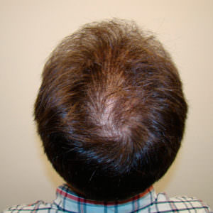 Pluggy Hair Transplant Correction Before And Afters Crown Difficult Cases Hairline 